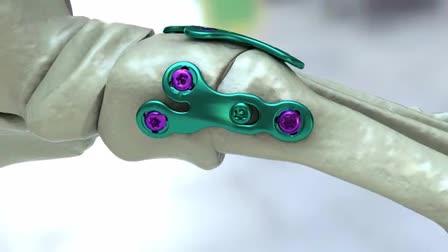 Orthohelix AAOS 2011 Reel