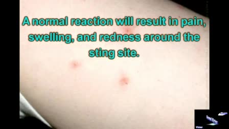 Insect Stings & Asthma