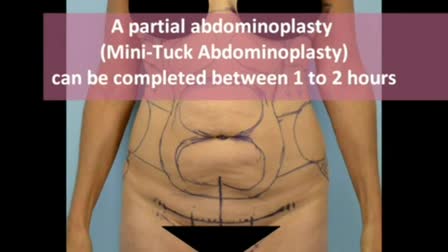 Abdominoplasty short video