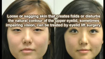 Blepharoplasty (Eye-Lid Surgery) Information from Sound Bytes