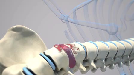 Bone Fusion