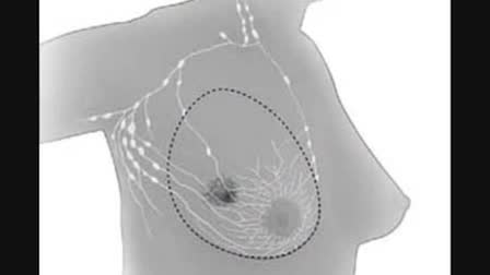 Medical Tip - Nipple Discharge