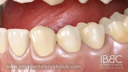 Periodontal dental animation